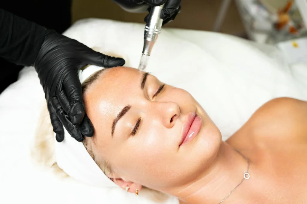 RF Microneedling Bellevue WA