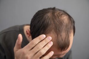 Close up of a man looking down and showing the balding on his head, in need of PRP treatments
